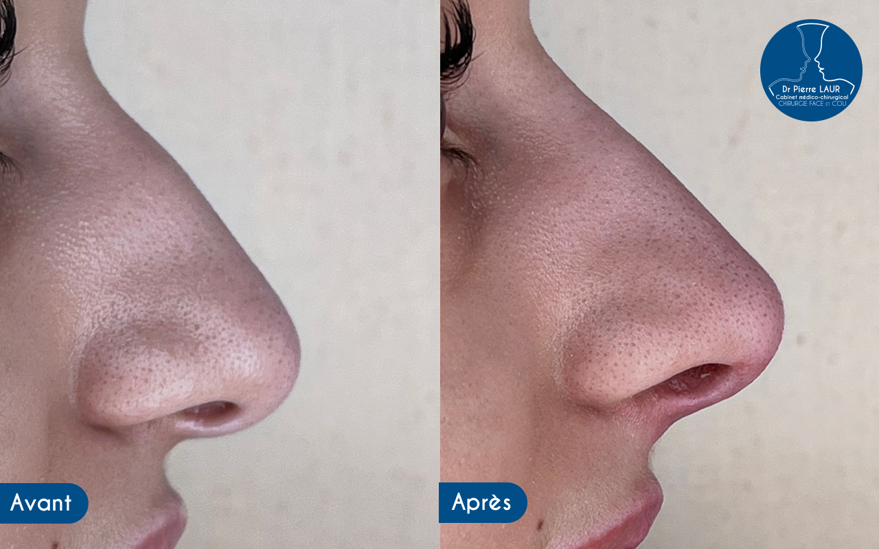 Modifier et améliorer mon nez Médecine esthétique à Périgueux