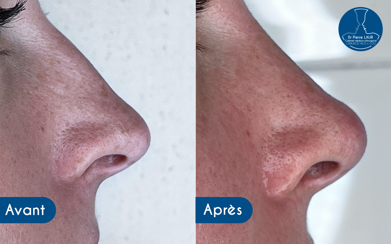 Modifier et améliorer mon nez Médecine esthétique à Périgueux